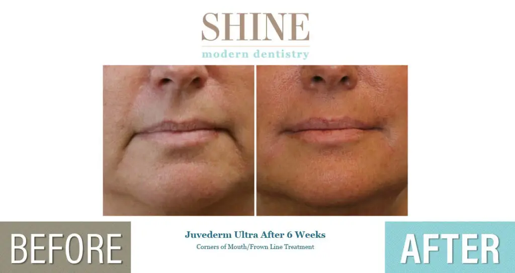 Shine - Before And After 10