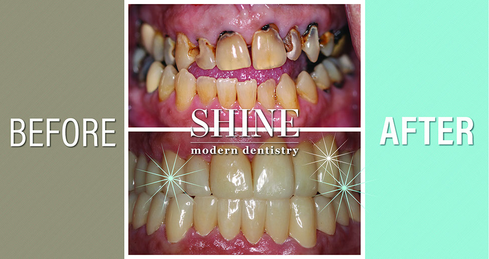 Shine - Before And After 9