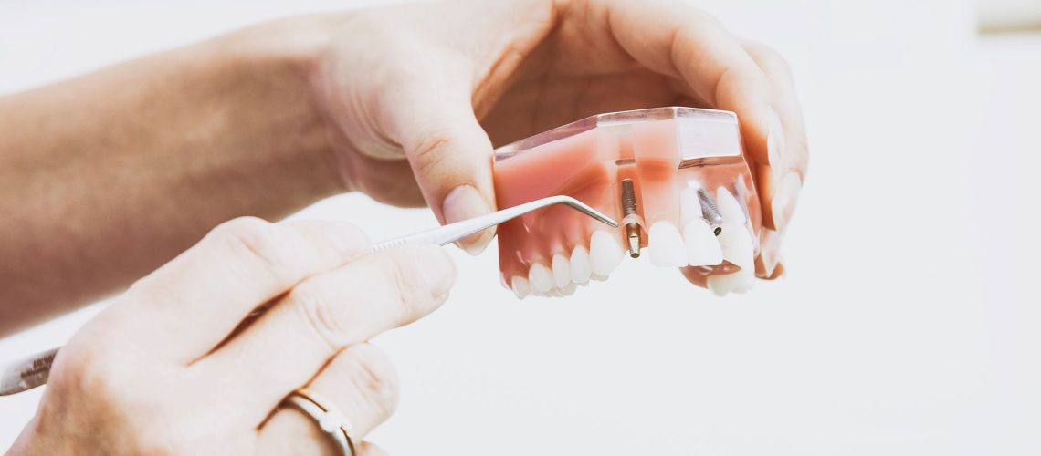 Denture-Stability-Dental-Implants-1
